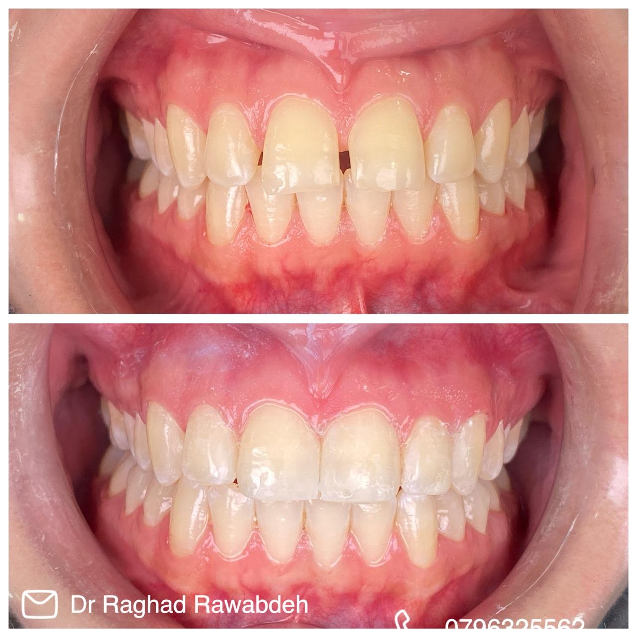 ترميم الاسنان باستخدام الحشوات التجميلية